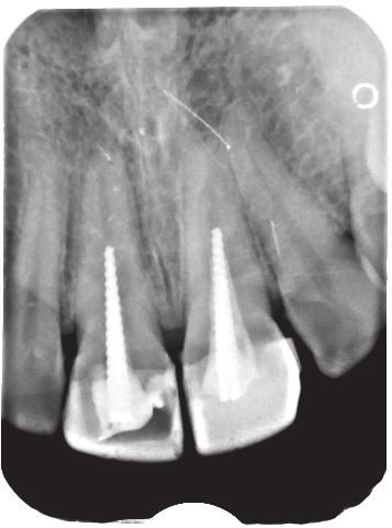 J Stoma 2016; 69, 5 Olczak K., Pawlicka H. Fig. 1. Teeth 11 and 21 with standard crown-root inlays cemented without previous root canal treatment.