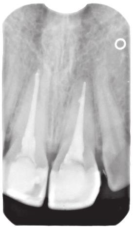 Next, the working length was measured and the canals were chemo-mechanically prepared using ProTaper Universal tools (Dentsply Maillefer ).
