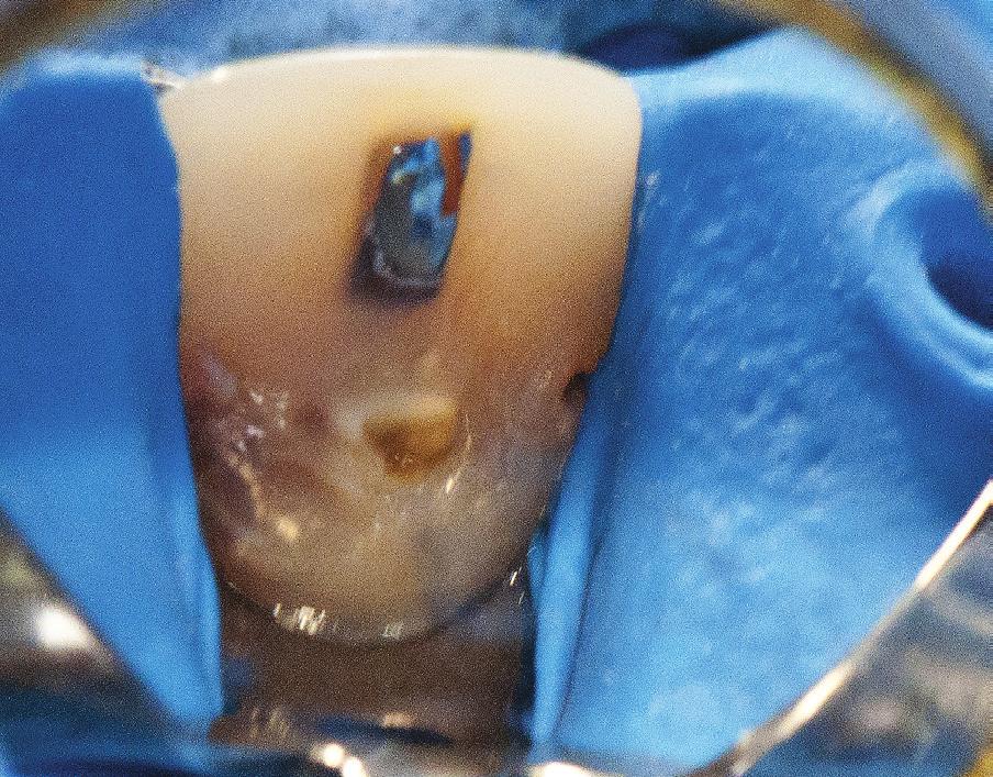 Removal of posts from root canals using ultrasounds defects were filled with temporary glass ionomer material (Fuji ). After the procedure, the control X-ray was taken (Fig. 3).