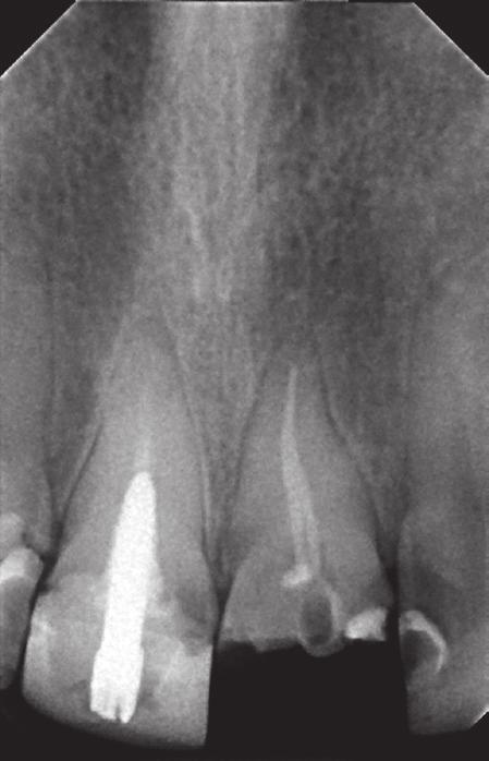 The patient was not satisfied with the current appearance of the tooth crown (Fig. 4). Additionally, she reported transient discomfort from tooth 11.