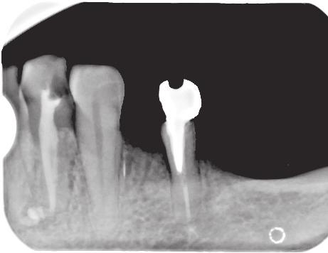 J Stoma 2016; 69, 5 Olczak K., Pawlicka H. treatment (Fig. 5).