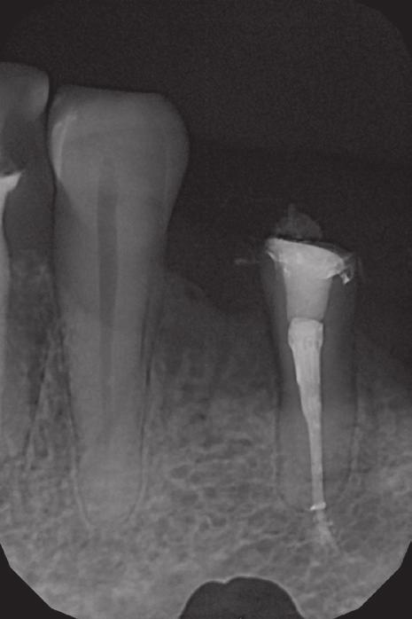 Then, thanks to the vibrations of ultrasound waves the post was removed and root canal re-treatment began.