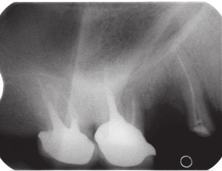 Removal of posts from root canals using ultrasounds J Stoma 2016; 69, 5 SDR composite material (Dentsply Maillefer ). After taking the control X-ray (Fig.