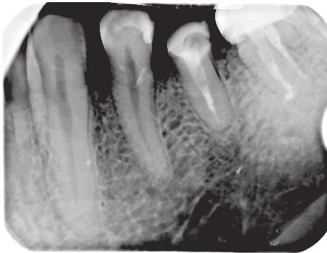 J Stoma 2016; 69, 5 Olczak K., Pawlicka H. Fig. 12. Tooth 45 before root canal re-treatment. A cemented fibre glass inlay is visible. No reconstruction of the coronal part of the tooth.