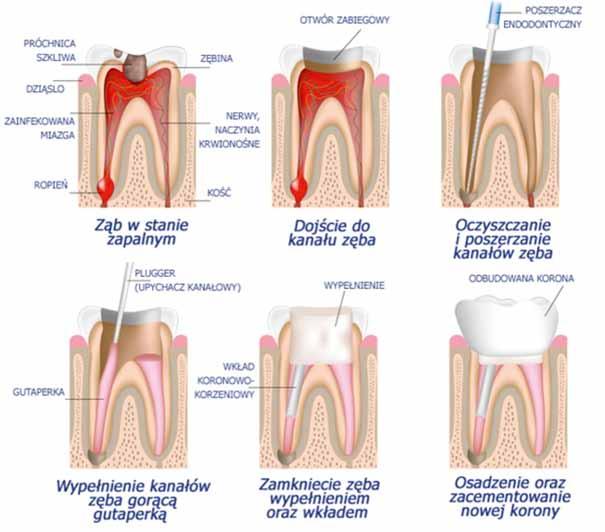 Leczenie kanałowe endodontyczne Kiedy ubytek próchnicowy sięga bardzo głęboko lub kiedy ząb zostaje złamany, dochodzi do zainfekowania miazgi ( nerwu) bakteriami.