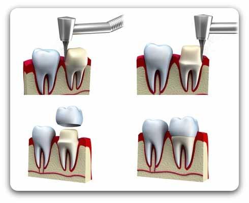 Protetyka Korona protetyczna W sytuacji, kiedy twarde tkanki zęba są zniszczone tak bardzo, że metody leczenia zachowawczego (wypełnienie lub odbudowa kompozytem światłoutwardzalnym) nie rokują