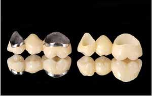 Protetyka Mosty protetyczne Prace protetyczne uzupełniające braki jednego lub większej ilości zębów (przęsła