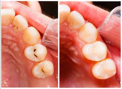 Wypełnienia W wyniku działania bakterii znajdujących się na powierzchniach zębów, których największe ilości znajdują się w płytce nazębnej, dochodzi do powstawania kwasów, które rozpuszczają twarde