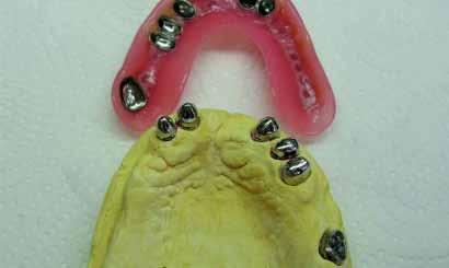 protezy w jamie ustnej z pełną estetyką.