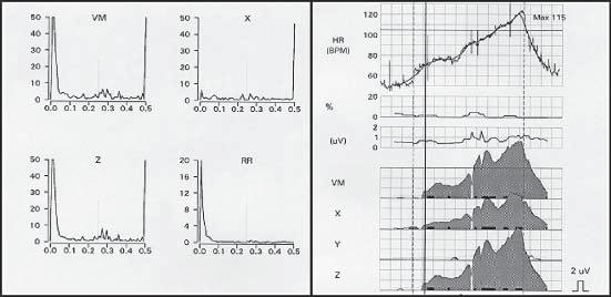 Folia Cardiologica Excerpta 2008, tom 3, nr 10 Widmo (uv^2) Widmo (uv^2) Widmo (ms^2) Widmo (uv^2) Odstęp niepra widłowych Szum Rycina 1.