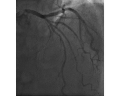 Kardiologia Inwazyjna nr 6 (11), ROK 2016 Rycina 2A. Sonda FFR w obwodzie GPZ wynik 0,61 Rycina 2B. Sonda FFR w gałęzi diagonalnej drugiej wynik 0,88 wnątrzwieńcowej (IVUS, intravascular ultrasound).