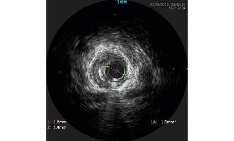 ). Uzyskane przed zabiegiem implantacji stentu obrazy pokazuje rycina 3. Badanie IVUS uwidoczniło, że blaszka miażdżycowa narastała od ujścia gałęzi diagonalnej drugiej (średnica światła ok.