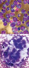 Nowotwory serca u psów i kotów 11 surowiczego przy ocenie cytologicznej preparatów należy być bardzo ostrożnym i wysuwać podejrzenie procesu nowotworowego dopiero wówczas, gdy stwierdza się obecność