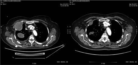 Małgorzata Wachowiak, Przypadek pacjentki z czerniakiem Rycina 1. Obraz tomografii komputerowej z dnia 28 listopada 2016 r. (przed leczeniem) () i z dnia 6 marca 2017 r. (w trakcie 3.