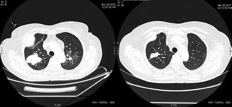 ONCOLOGY IN CLINICL PRCTICE 2018, Vol. 14, Suppl. Rycina 3. Obraz tomografii komputerowej z dnia 28 listopada 2016 r. (przed leczeniem) () i z dnia 6 marca 2017 r. (w trakcie 3.