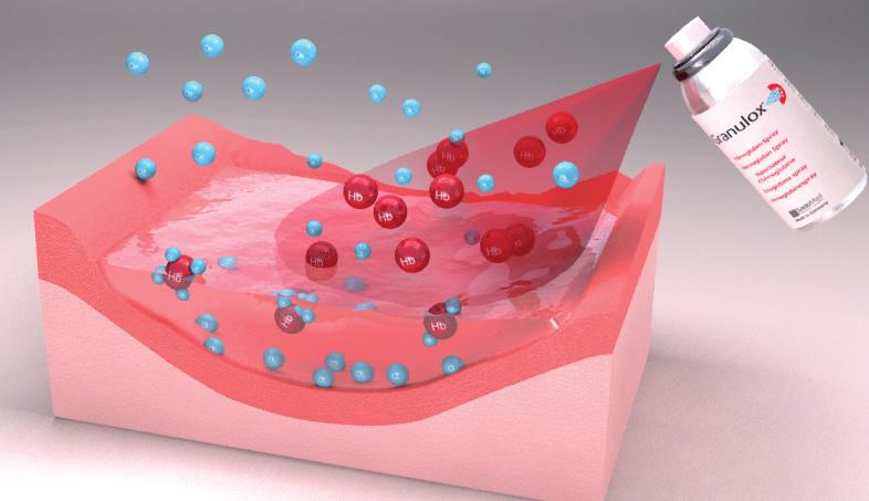 Zasada działania Unikalny sposób działania Granulox działa jako nośnik cząsteczek tlenu Granulox to innowacyjne rozwiązanie dla ran niegojących się oraz trudnych do