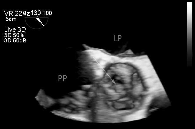 Współcześnie w diagnostyce PVE stosuje się najbardziej zaawansowane techniki TTE i TEE, charakteryzujące się wysoką rozdzielczością przestrzenną i czasową.