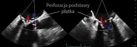 Widoczne zgrubienie objętego procesem zapalnym płatka zastawki biologicznej; B. TEE. Projekcja dwupłaszczyznowa, środkowa (3C/4C). Rejestracja przepływów za pomocą kolorowego doplera przez bioprotezę.