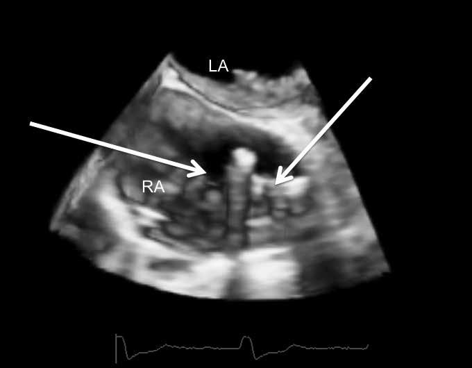 implantowanych: lokalne zakażenie urządzenia (LDI, local device infection) i zapalenie wsierdzia związane z urządzeniami kardiologicznymi (CDRIE, cardiac device-related infective endocarditis).
