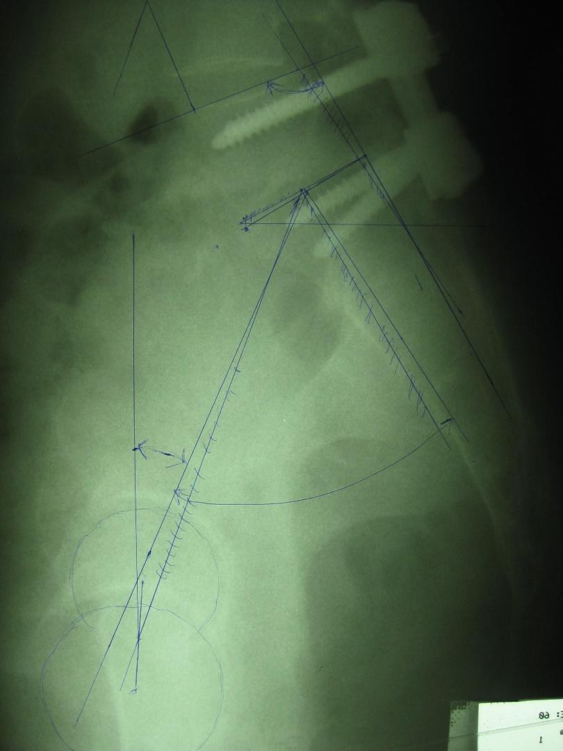Improvement of pelvis balance (Δ