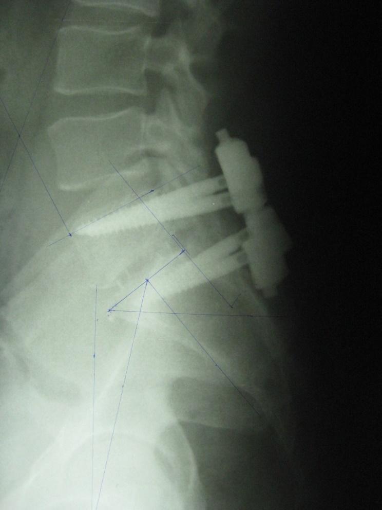 Worsening of pelvis balance Balanced Balanced 107 o 105 o 7 o 11 o 41 o 31 o
