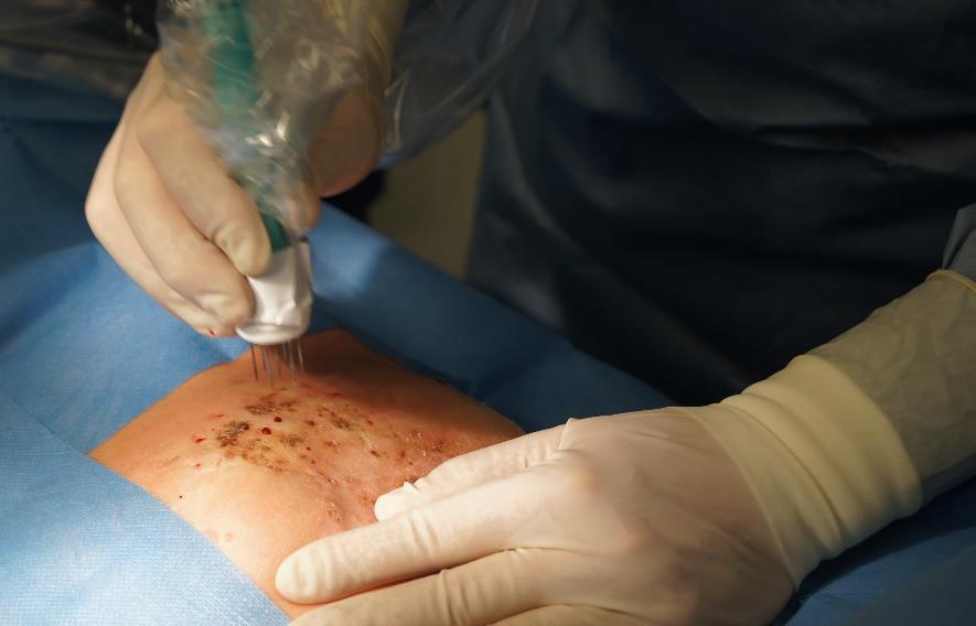 INNE PROCEDURY WSKAZANE W LECZENIU RAKA PIERSI Hipertermia Podanie chemioterapii z zastosowaniem hipertermii zwiększa skuteczność chemioterapii neoadjuwantowej.