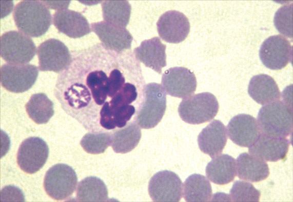 Metody rozpoznawania anaplazmozy granulocytarnej u psów 1 Anaplazmoza granulocytarna to transmisyjna, wielonarządowa choroba ludzi i zwierząt, przebiegająca z trombocytopenią [1-6].