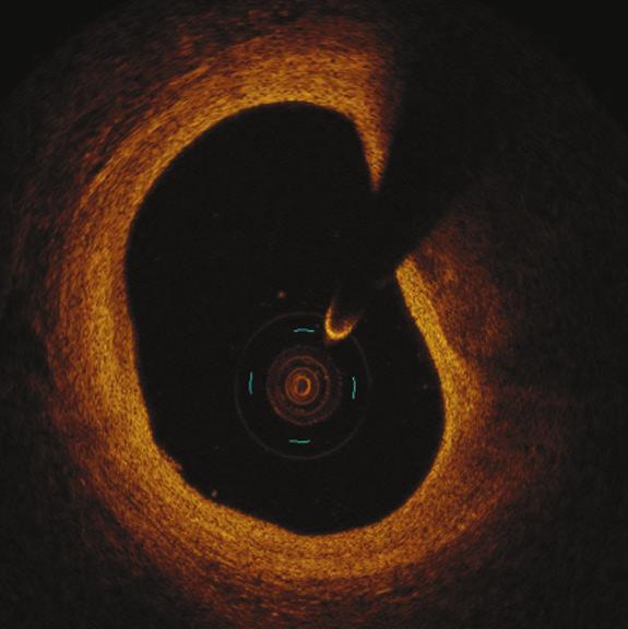 Wysoka rozdzielczość obrazów uzyskanych za pomocą OCT, sięgająca 10 15 μm i 10-krotnie przewyższająca jakość badania IVUS, pozwala na precyzyjną wizualizację zarówno zmian miażdżycowych w tętnicach