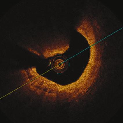 Optyczna tomografia koherentna umożliwia dokładny pomiar grubości i dystrybucji neointimy (ryc. 8, 9).