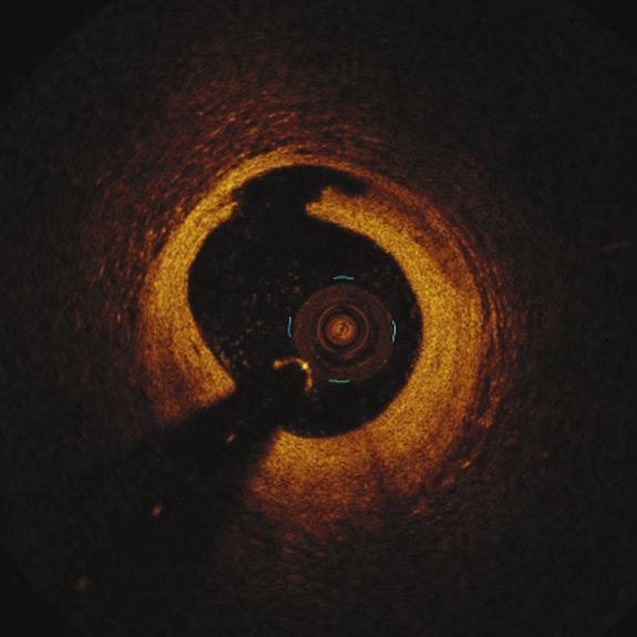 Choroby Serca i Naczyń 2018, tom 15, nr 2 Rycina 7. Naczynie wieńcowe bezpośrednio po zabiegu angioplastyki brzeżna dyssekcja niewidoczna w angiografii obraz optycznej Rycina 9.