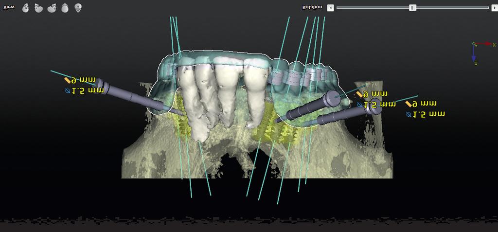 J Stoma 2017; 70, 1 Łomżyński Ł., Mierzwińska-Nastalska E. Fig. 1. NobelClinician 3-D visualization of hard tissues with a radiographic template and planned implants.