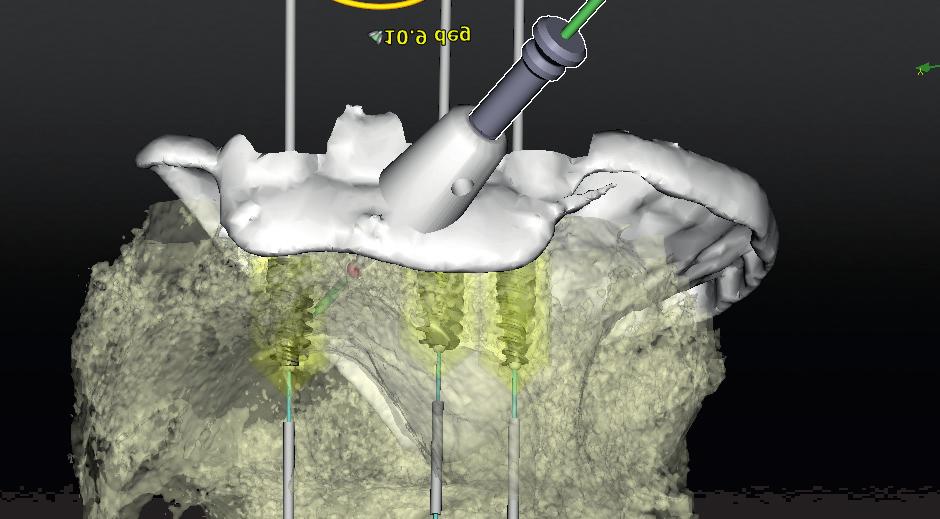 Evolution of computer-assisted planning systems used in implant dentistry... J Stoma 2017; 70, 1 Fig. 3. NobelClinician bone transparency function.