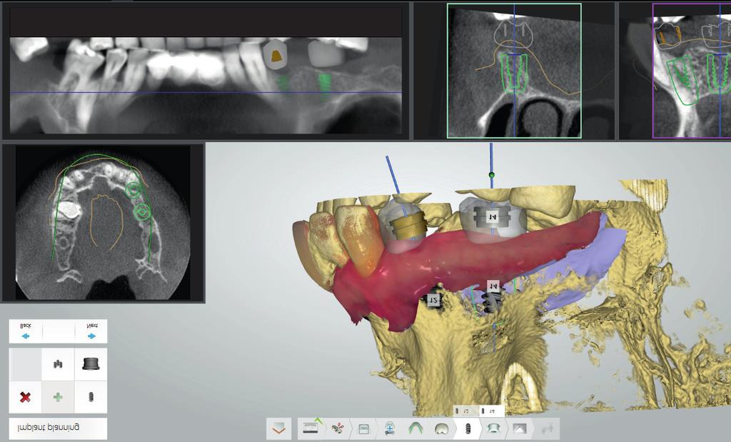 Evolution of computer-assisted planning systems used in implant dentistry... J Stoma 2017; 70, 1 Fig. 5.