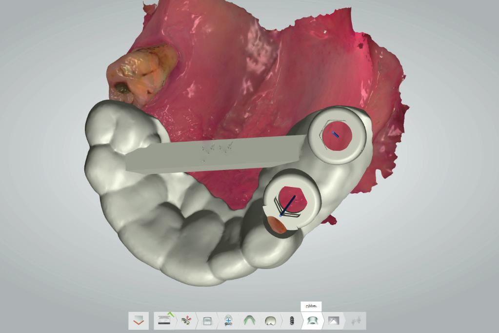 J Stoma 2017; 70, 1 Łomżyński Ł., Mierzwińska-Nastalska E. Fig. 6. ImplantStudio custom design of surgical stent. ImplantStudio indywidualnie wykonany projekt szablonu chirurgicznego. Fig. 7. Surgical stent in ImplantStudio a close-up of a reinforcing bar and a doctor s tag.