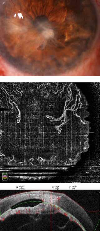 Obecność artefaktów jest spowodowana złą współpracą pacjenta podczas badania. Fig. 4. OCT-A demonstrating numerous artifacts presenting as horizontal white lines.