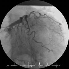 70/min, blok przedniej wi¹zki lewej odnogi pêczka Hisa, cechy przeci¹ enia lewej komory. ECG of the patients- sinus rhythm 70 Hz, left anterior bundle branch block, LV hypertrophy.
