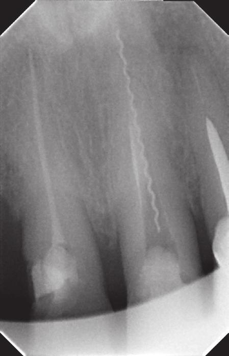 Management in cases of instruments fractured in the root canal system J Stoma 2016; 69, 3 Material and methods Case studies Case 1 A 40-year-old patient was sent for re-treatment of the root canal 21.