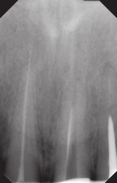 tissues, beyond the anatomical foramen of the root (Fig. 1). At the start of the procedure the rubber dam was placed and the filling was removed from the palatal surface of the tooth.