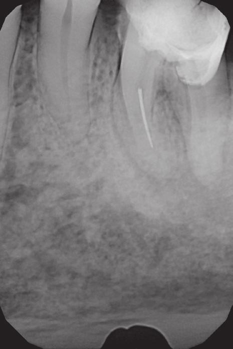 J Stoma 2016; 69, 3 Olczak K., Pawlicka H. Maillefer ), and the defect was temporarily filled with Fuji IX glass ionomer material (GC ).