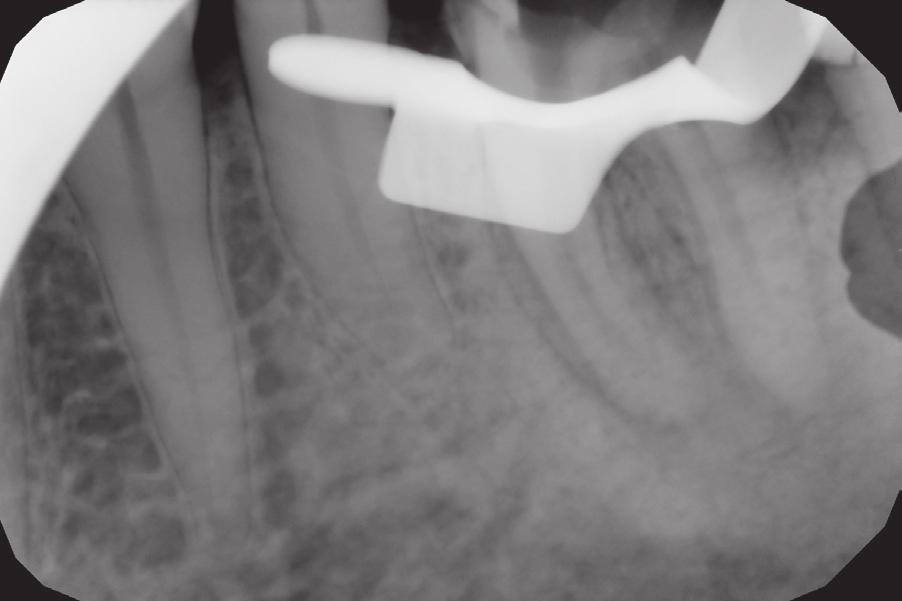 Management in cases of instruments fractured in the root canal system J Stoma 2016; 69, 3 Fig. 6. X-ray picture of tooth 36 after instrument removal.