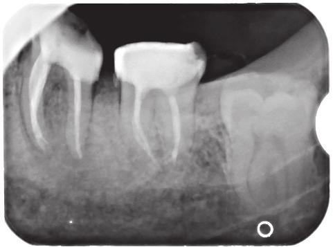 The canal openings were secured with flow composite and the defect was temporarily filled with Fuji IX glass ionomer (GC ). After the surgery, an X-ray was taken (Fig. 8).