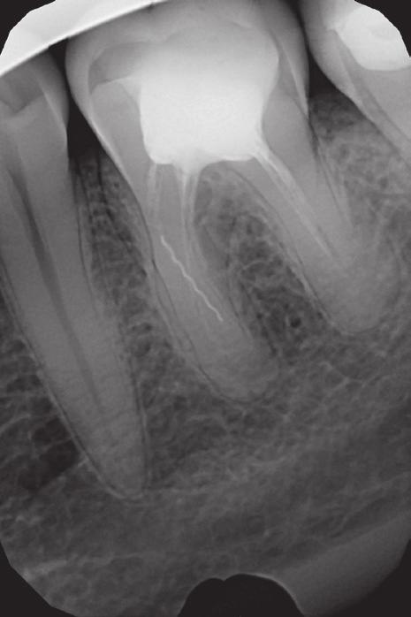 J Stoma 2016; 69, 3 Olczak K., Pawlicka H. Fig. 9. X-ray picture of tooth 46 before treatment. Visible fragment of a broken canal instrument. Zdjęcie rentgenowskie zęba 46 przed leczeniem.