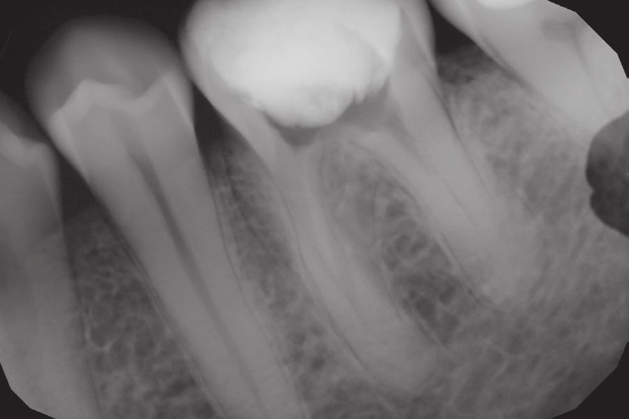 Złamany fragment igły Lentulo po usunięciu z zęba 46. Fig. 12. Tooth 46 after the final canal filling. Ząb 46 po ostatecznym wypełnieniu kanałów korzeniowych.