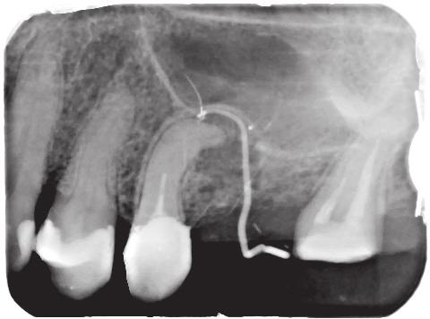Management in cases of instruments fractured in the root canal system J Stoma 2016; 69, 3 Fig. 13. X-ray picture of tooth 25 with the gutta-percha cone inserted into the fistula.