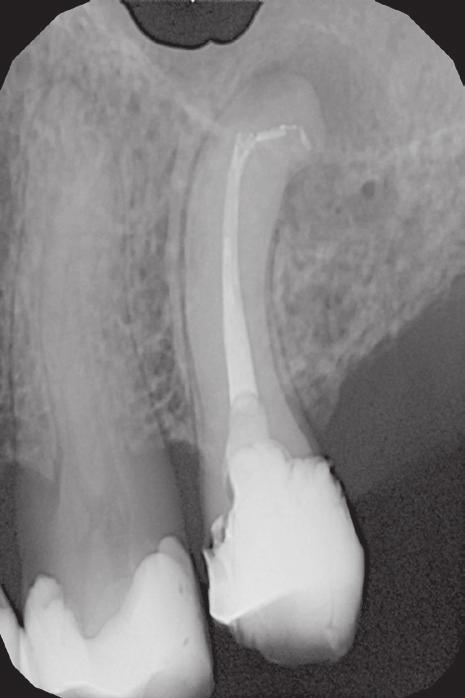 Zdjęcie rentgenowskie zęba 25 po ostatecznym wypełnieniu kanału korzeniowego. Fig. 15. Control X-ray of tooth 25, taken one year after the end of treatment.
