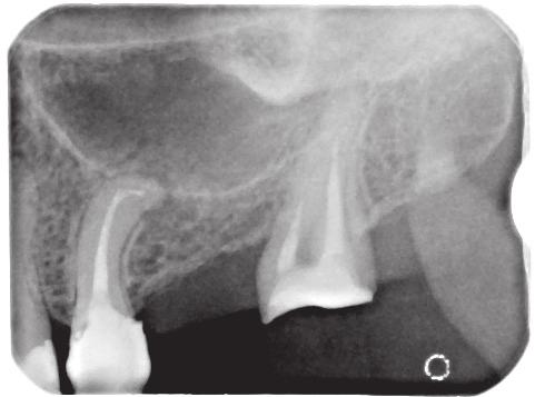 The clinical examination revealed internal fistula around the root apex of tooth 25. An X-ray picture was taken with the gutta-percha cone inserted into the fistula (Fig. 13).