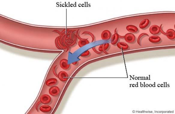 Anemia sierpowatokrwinkowa Postać hemoglobinopatii spowodowana mutacją w obrębie łańcucha β