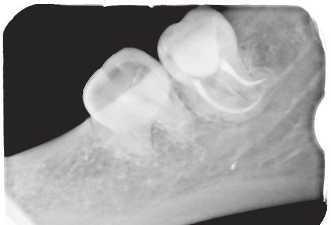 X-ray of tooth 38 after the final preparation and filling root canals. Zdjęcie rentgenowskie zęba 38 po ostatecznym opracowaniu i wypełnieniu kanałów korzeniowych.