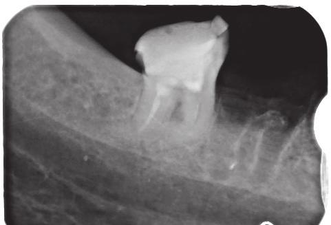 Root canal treatment of teeth with curved root canals J Stoma 2017; 70, 5 Fig. 3. X-ray of tooth 48 prior to root canal retreatment. The visible result of inadequate primary root canal treatment.