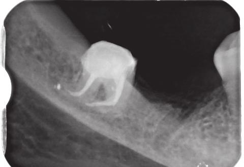 Widoczny efekt nieprawidłowego, pierwotnego leczenia kanałowego. Kanały nieopracowane i niewypełnione na całej długości. Fig. 4. X-ray of tooth 48 after the final preparation and retreatment.